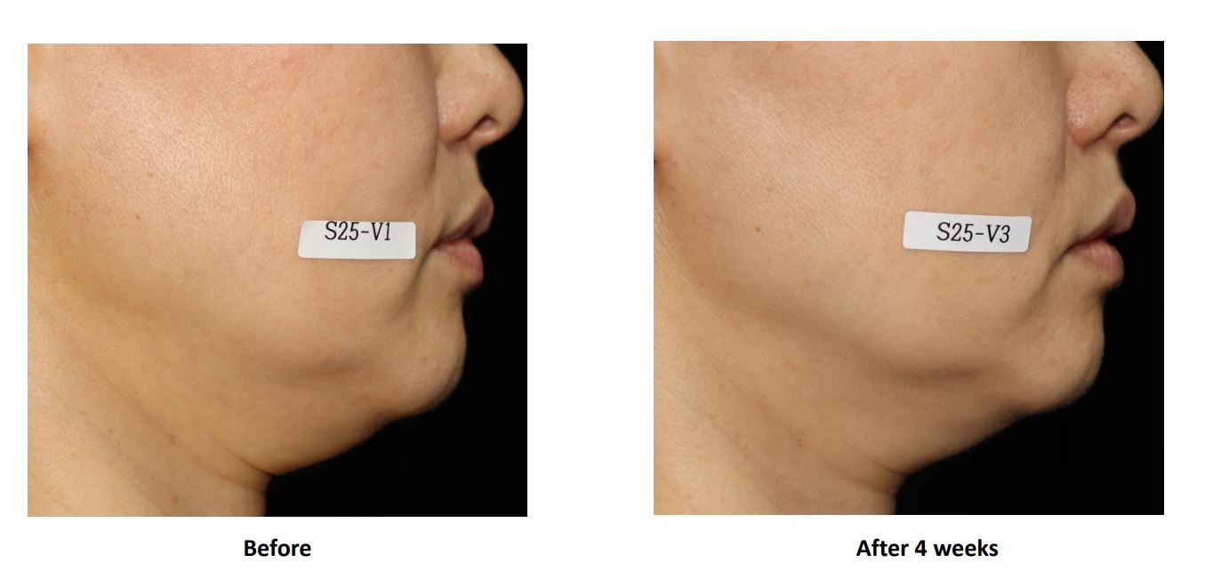 Cell Return Tightening Before & After