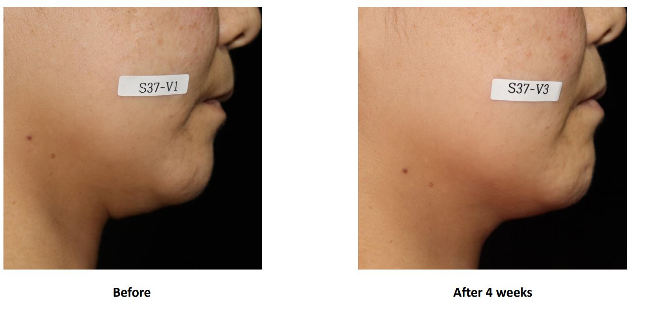 Cell Return Tightening Before & After 2